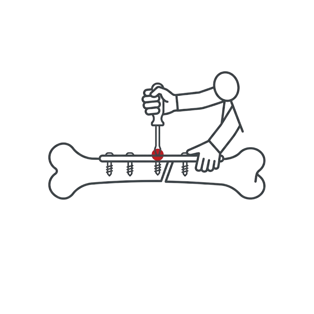Fijación de fracturas